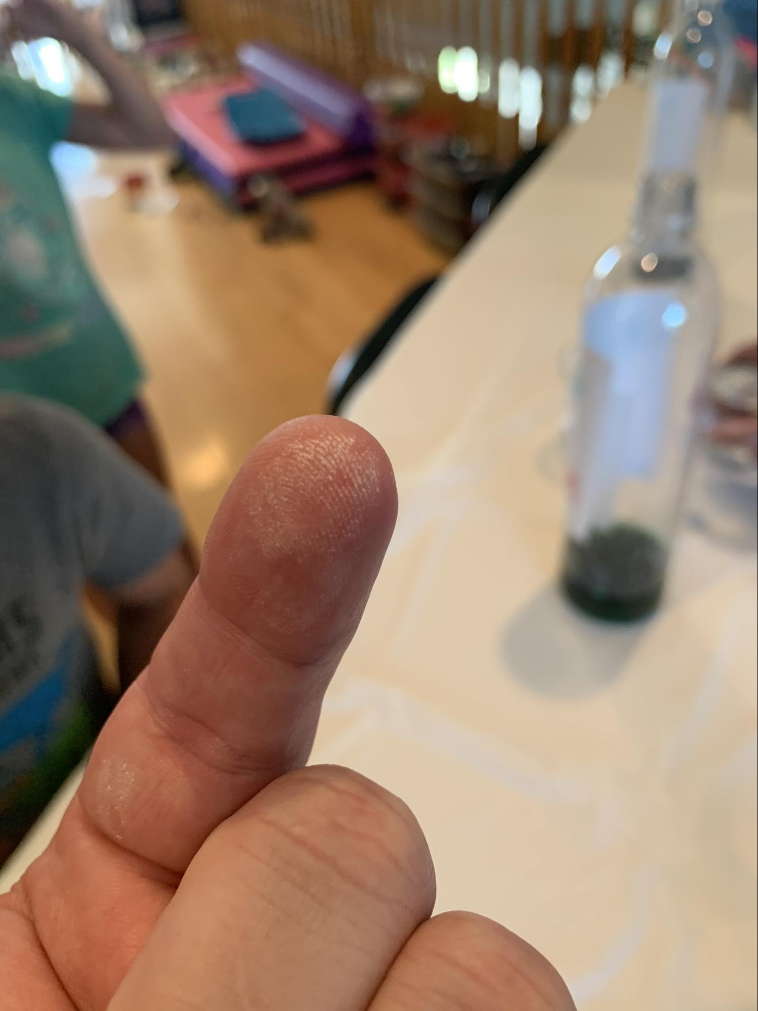 finger with irritated skin from touching hydrogen peroxide in Elephant Toothpaste experiment